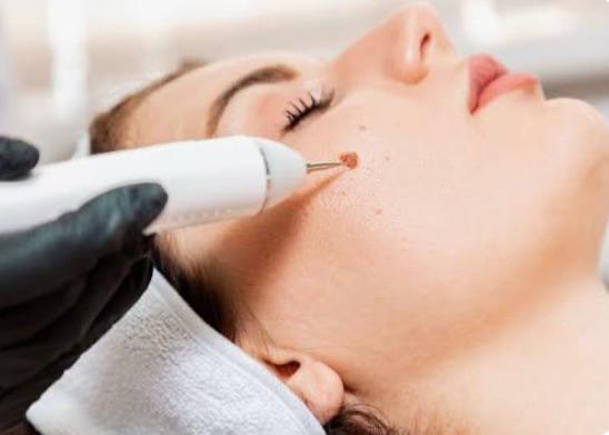 tratamento de Remoção de pintas e verrugas