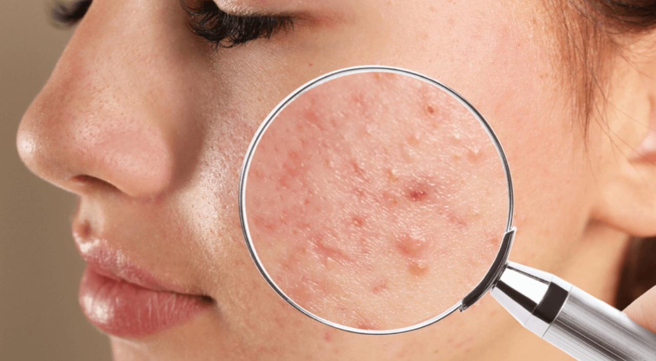 tratamento de Tratamento de Acne
